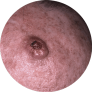 Invazivní spinocelulární karcinom
